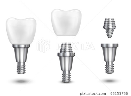Tooth implant vector illustration 96155766