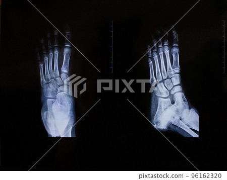 X-ray of the foot in two projections 96162320