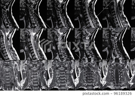 High resolution MRI scan of cervical spine. Real spine MRI scan. 96189326