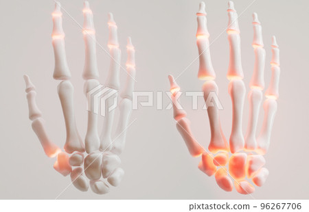 Rheumatoid arthritis and finger polyarthrosis in comparison - 3D rendering Rheumatoid arthritis and finger polyarthrosis in comparison - 3D rendering 96267706