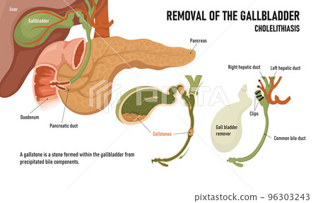 Cholecystitis. Inflammation of the gallbladder and bile ducts. Gallstones. Removal of the gallbladder Cholecystitis. Inflammation of the gallbladder and bile ducts. Gallstones. Removal of the gallbladder 96303243