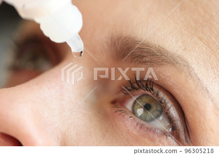 Caucasian woman using medical drops and dripping eye close up. Caucasian woman using medical drops and dripping eye close up. 96305218