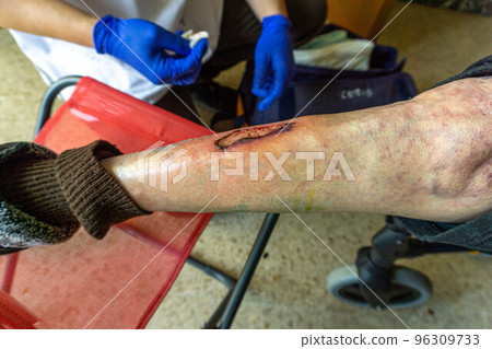 varicose ulcer on one leg varicose ulcer on one leg 96309733