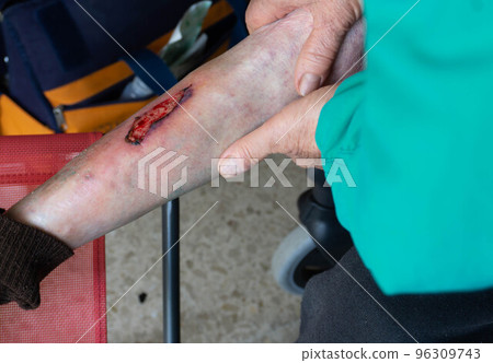 varicose ulcer on one leg varicose ulcer on one leg 96309743