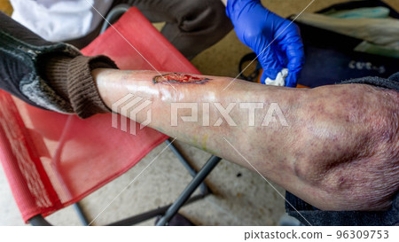 varicose ulcer on one leg 96309753