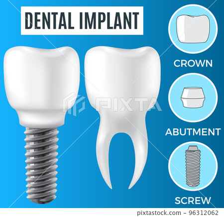 Realistic white dental implant and human tooth. Dentistry, medicine and oral cavity health 96312062
