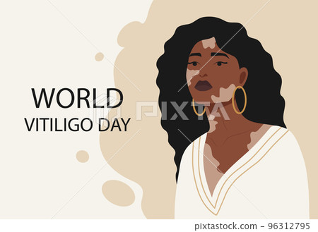 Young afro american girl illustration with vitiligo banner. 96312795