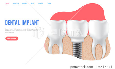 Human jaw with normal healthy teeth and prosthesis in gum above structure of dental implant Human jaw with normal healthy teeth and prosthesis in gum above structure of dental implant 96316841