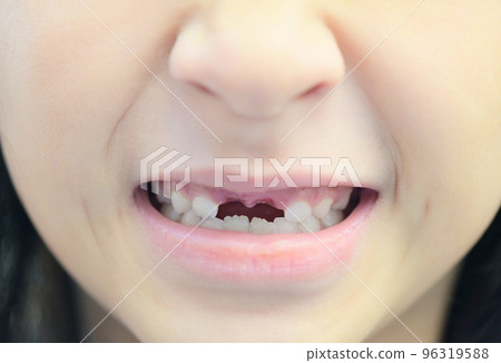 lost milk teeth - lost baby tooth , smile face of a child girl baby teeth of tooth loss , her milk tooth fell out and her growing permanent tooth in open mouth dental health problems concept lost milk teeth - lost baby tooth , smile face of a child girl baby teeth of tooth loss , her milk tooth fell out and her growing permanent tooth in open mouth dental health problems concept 96319588