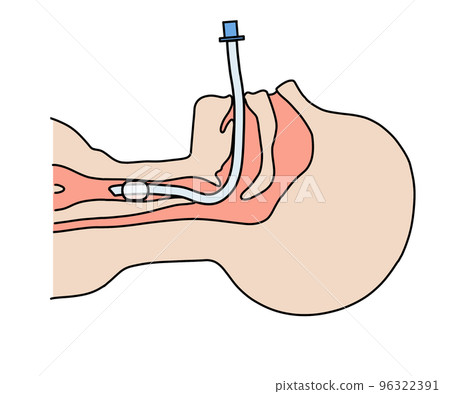 endotracheal tube 96322391