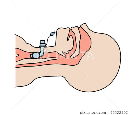 氣管切開管 96322392