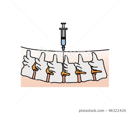 nerve root block nerve root block 96322420