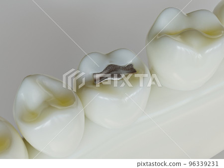 Amalgam restorationn in a tooth - 3D Rendering 96339231