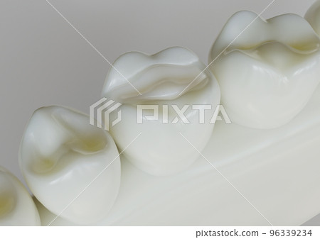 Ceramic Inlay crown in a tooth- 3D Rendering 96339234