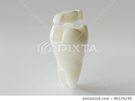 Ceramic Inlay crown over a tooth- 3D Rendering 96339246