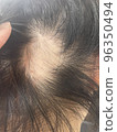 female alopecia areata 96350494