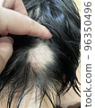 female alopecia areata 96350496