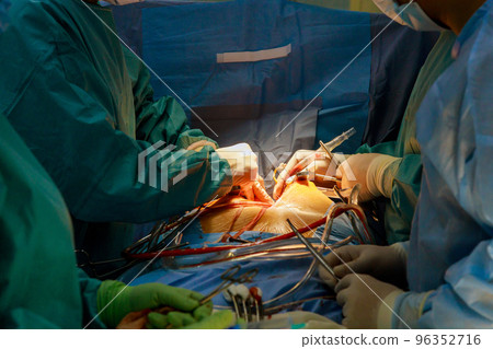 Open heart surgery due to malfunction of the heart valve, valve replacement is performed in the hospital operation room Open heart surgery due to malfunction of the heart valve, valve replacement is performed in the hospital operation room 96352716