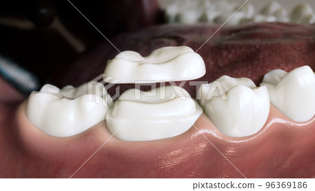Ceramic Overlay crown over a tooth- 3D Rendering 96369186