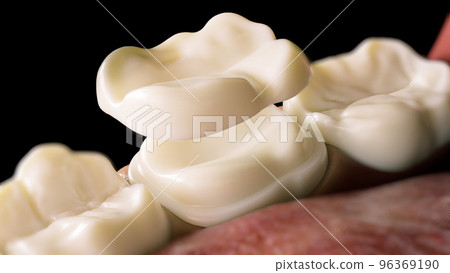Ceramic Overlay crown over a tooth- 3D Rendering 96369190