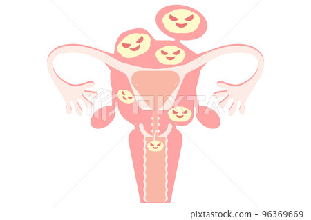 multiple fibroids multiple fibroids 96369669