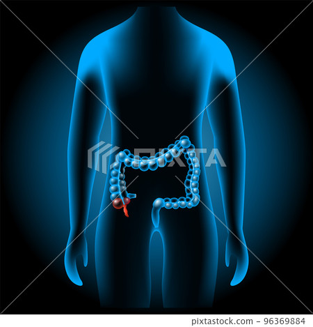 Appendicitis. inflammation of the appendix 96369884
