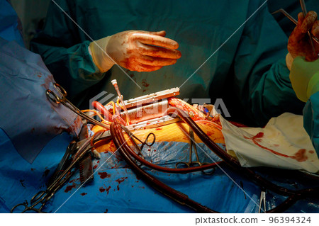 As part of heart operations due to coronary heart disease that are being performed in operating room hospital, coronary artery bypass grafts are being performed 96394324