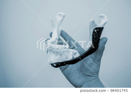 Person holding in hand 3D printed plastic prototype human lower jaw and medical titanium implant close-up. Prosthesis anatomical bone 3D printed from metal powder. Orthopedic maxillo-facial prosthesis 96401745