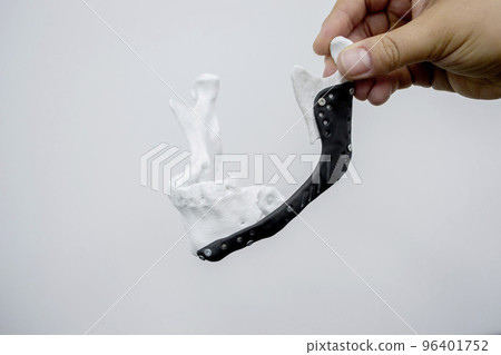 Person holding in hand 3D printed plastic prototype human lower jaw and medical titanium implant close-up. Prosthesis anatomical bone 3D printed from metal powder. Orthopedic maxillo-facial prosthesis 96401752