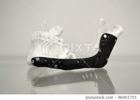 3D printed plastic prototype human lower jaw and medical titanium implant close-up. Black prosthesis prototype anatomical human bone 3D printed from metal powder. Orthopedic maxillo-facial prosthesis 96401755