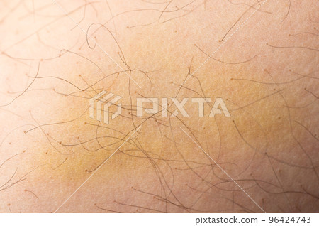 Injured human skin 96424743