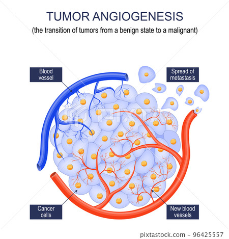 Tumor angiogenesis Tumor angiogenesis 96425557