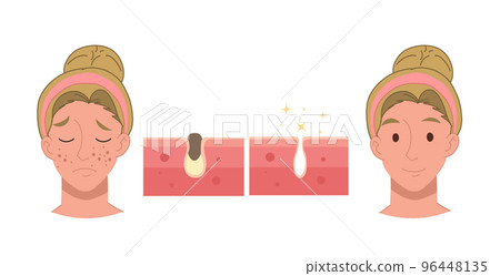 Acne treatment before after concept, facial cleansing foam, Vector cartoon illustration Acne treatment before after concept, facial cleansing foam, Vector cartoon illustration 96448135