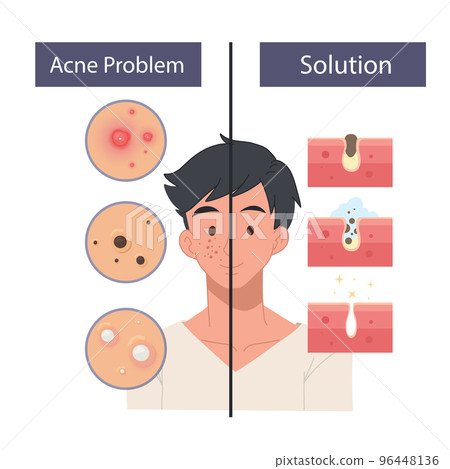 Face Care Men concept. Facial care, skin defects, skin problems, acne, facials. Facial care icons. 96448136