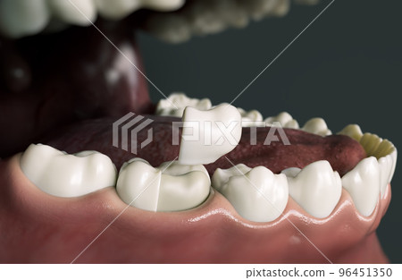 Ceramic Onlay quarter crown over a tooth- 3D Rendering 96451350