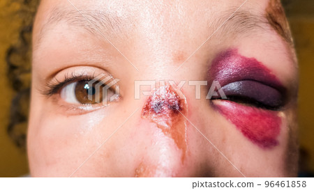 Girl with Black Eye, Shiner. Big bruise 96461858