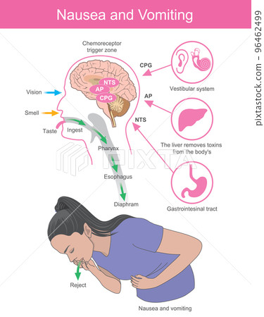 Nausea and Vomiting. A woman with symptoms the nausea and vomiting which is the effect of brain processes. 96462499