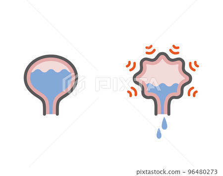 Overactive bladder and normal bladder icon 96480273