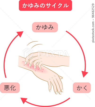 瘙癢週期手部濕疹 瘙癢週期手部濕疹 96482529