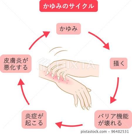 Itching cycle hand eczema 96482531