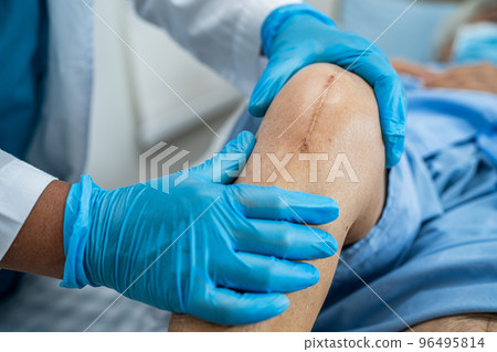 Asian senior or elderly old lady woman patient show her scars surgical total knee joint replacement Suture wound surgery arthroplasty on bed in nursing hospital ward, healthy strong medical concept. Asian senior or elderly old lady woman patient show her scars surgical total knee joint replacement Suture wound surgery arthroplasty on bed in nursing hospital ward, healthy strong medical concept. 96495814