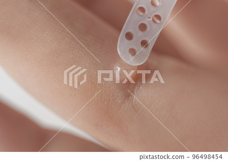 Apply the medicine to the wart with a special spatula or brush. Wart on the finger. Close-up plan of wart treatment. Human papillomavirus, HPV, treatment. Apply the medicine to the wart with a special spatula or brush. Wart on the finger. Close-up plan of wart treatment. Human papillomavirus, HPV, treatment. 96498454