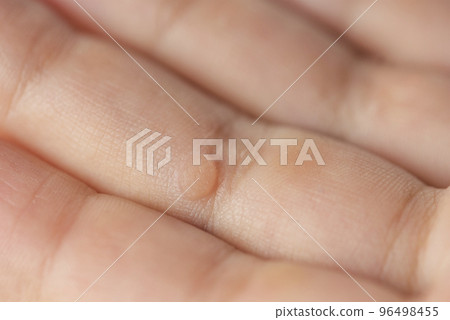 Wart on the finger. Close-up of a wart on a child's finger. The common wart Verruca vulgaris is caused by a type of human papillomavirus, HPV. Wart on the finger. Close-up of a wart on a child's finger. The common wart Verruca vulgaris is caused by a type of human papillomavirus, HPV. 96498455