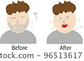 Before and after beard hair removal 96513617