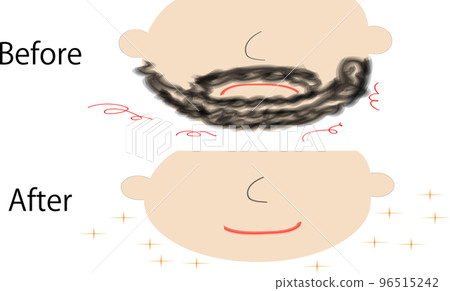 Before and after beard hair removal 96515242