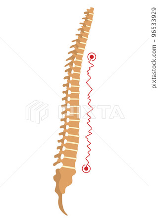 Spinal deformity. Symbol of spine curvatures or unhealthy backbones. Human spine anatomy, curved spine. Diagram with marked section. Body posture defect 96533929