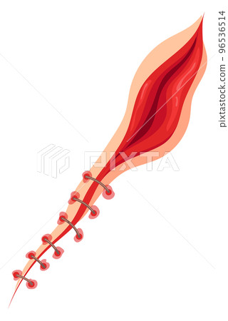 Injured skin. Bloody cut with surgical stitches. Body scar 96536514