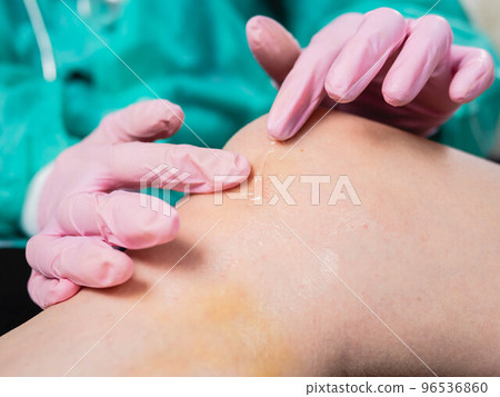 Close-up Applying a healing ointment to a bruise on the leg. Family doctor examines leg injury 96536860