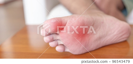man having bunion toes or blister due to wearing narrow shoes and waking or running longtime, barefoot pain due to Plantar fasciitis. Health and medical concept 96543479