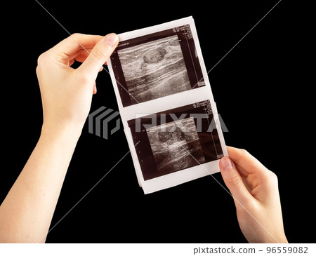 Breast scan in hands. Ultrasound diagnostics of cancer and fibroadenoma 96559082